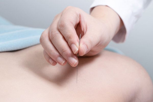 Acupuncture Burnaby