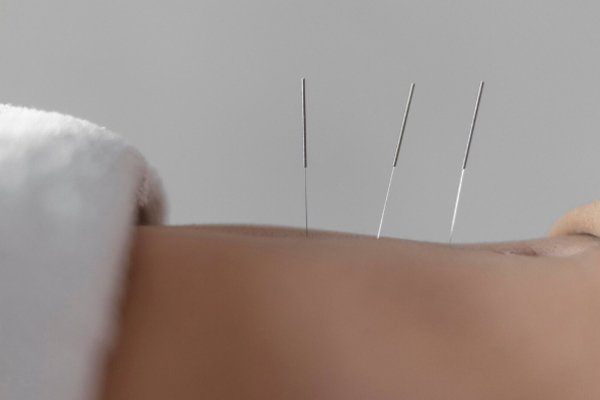 Acupuncture Burnaby BC