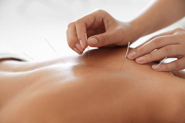 Acupuncture Vancouver BC