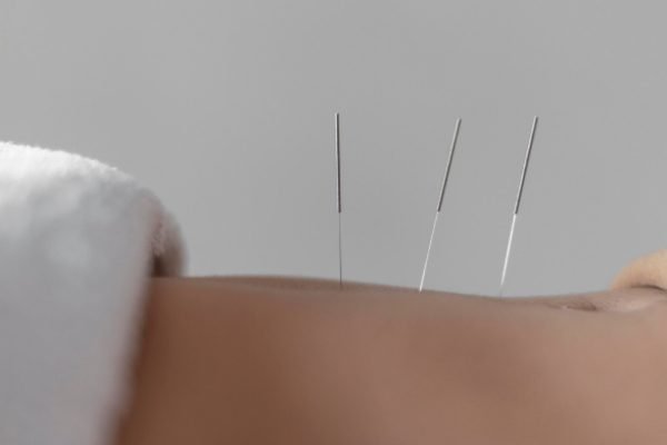 Abdominal acupuncture