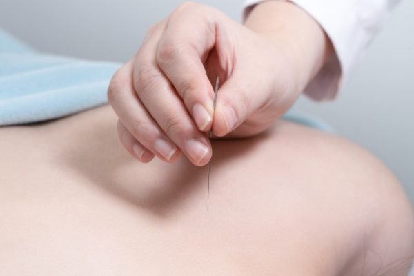 Acupuncture Vancouver BC